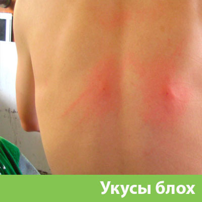 Укусы блох в Мелеузе