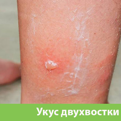 Укус двухвостки в Мелеузе
