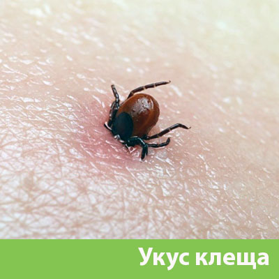 Укус клеща в Мелеузе