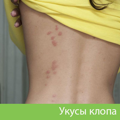 Профессиональное уничтожение клопов в Мелеузе